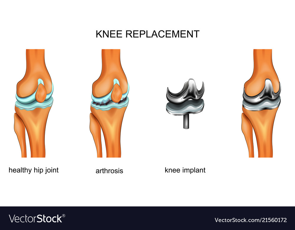 Knee Joint Endoprosthesis Royalty Free Vector Image