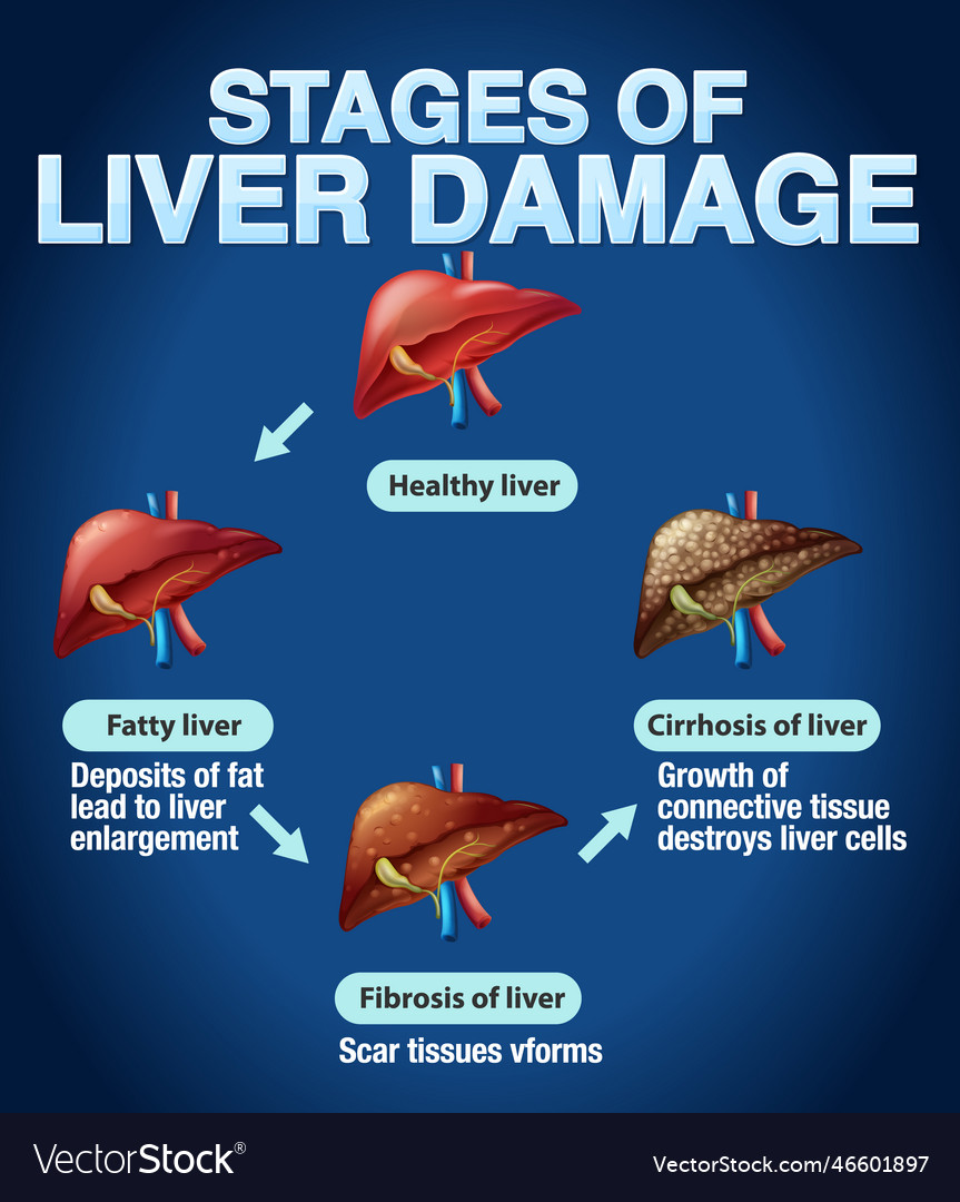 Stages Of Liver Damage Infographic Royalty Free Vector Image