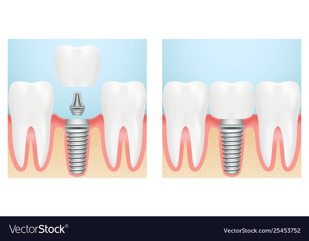 Human Teeth And Dental Implant Cut Scheme Stock Vector Image