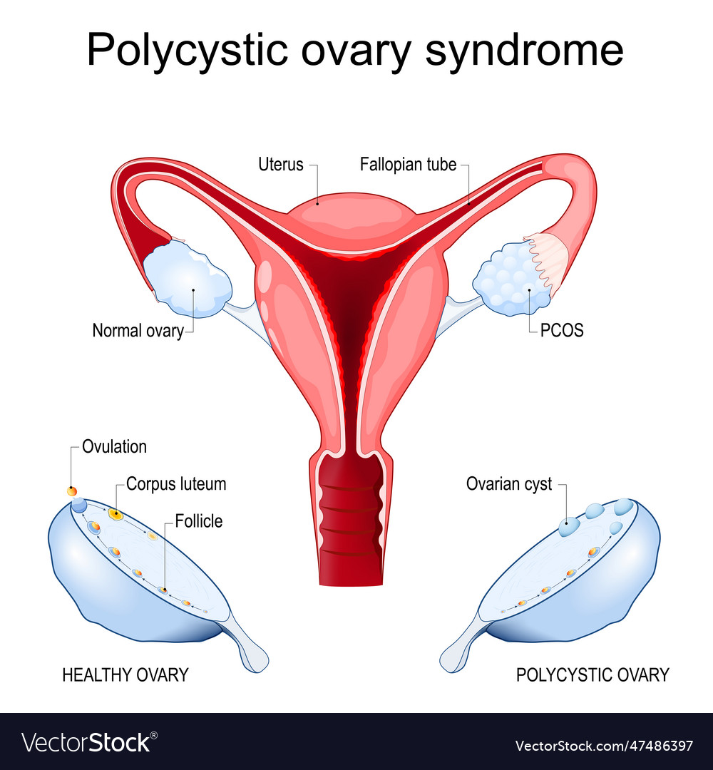 Polycystic Ovary Syndrome Royalty Free Vector Image