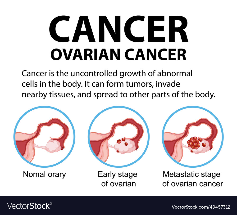 Woman Ovarian Cancer Infographic Stages Royalty Free Vector