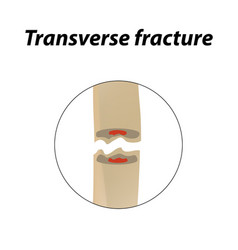 Types Fracture Fracture Bone Set Infographics Vector Image