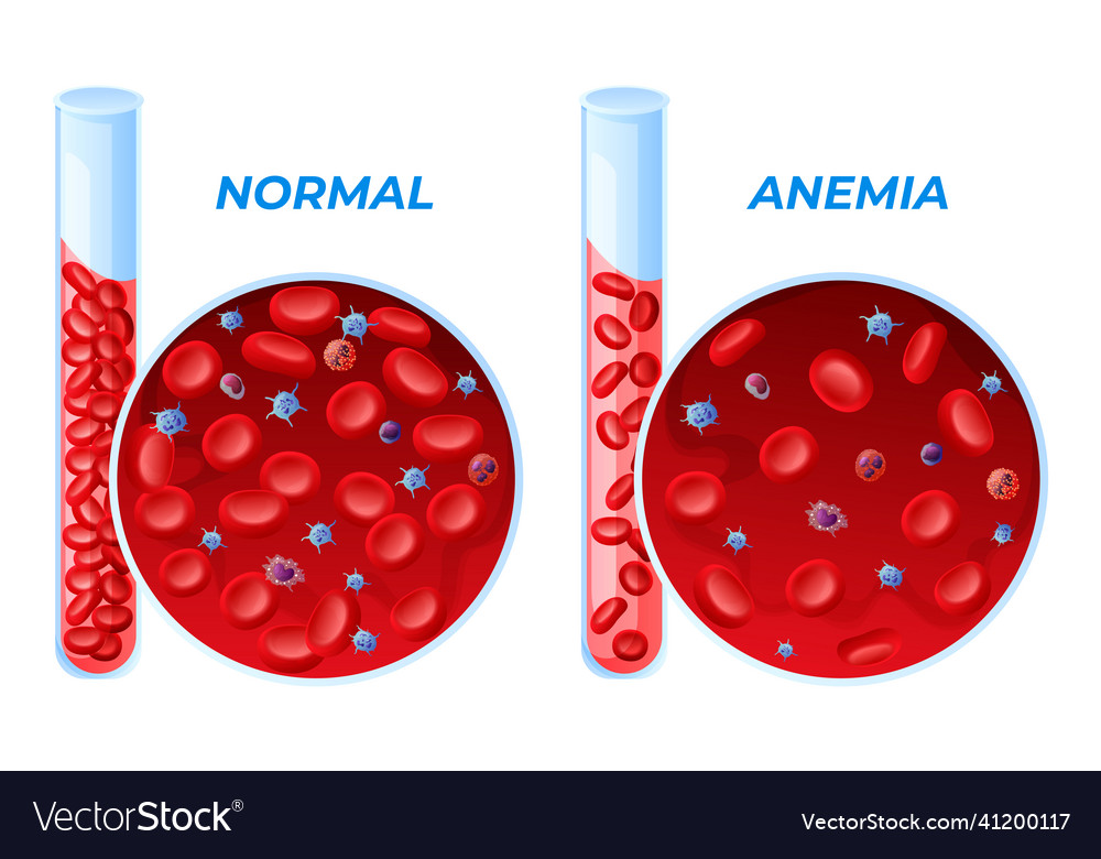 Iron Deficiency Anemia And Normal Set Royalty Free Vector