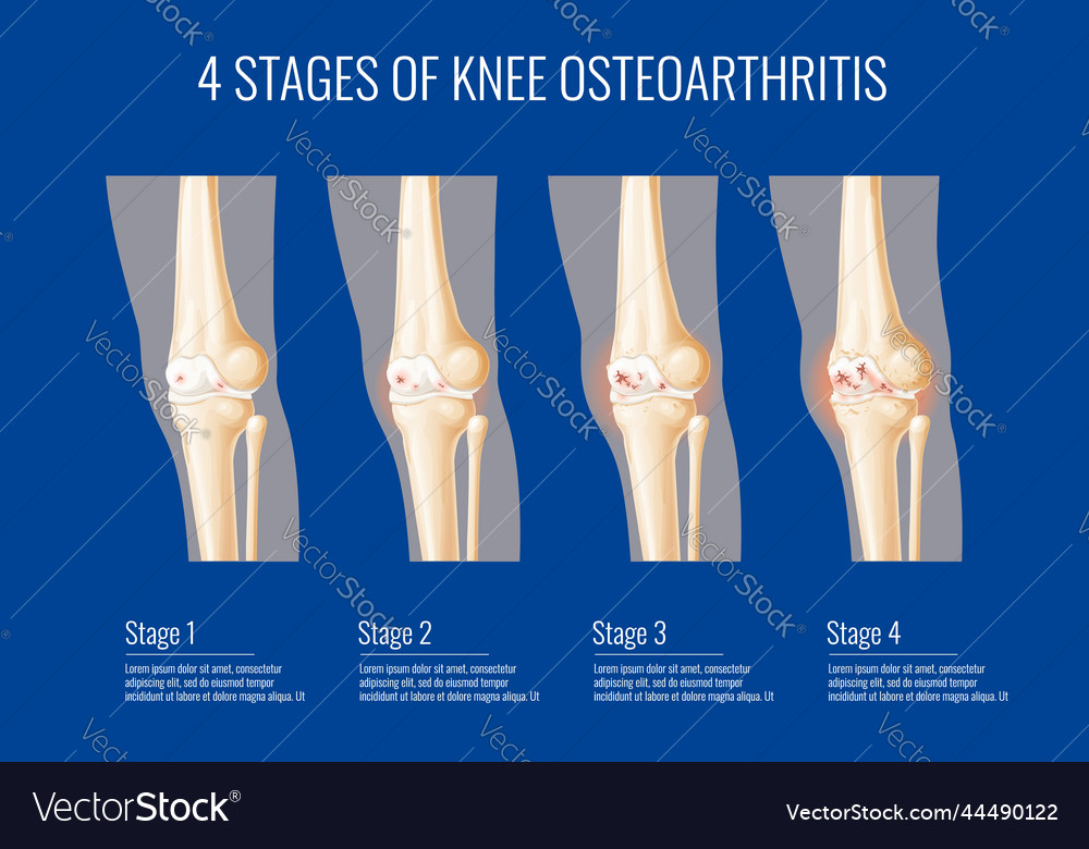 Knee Joint Osteoarthritis Stages Infographics Vector Image