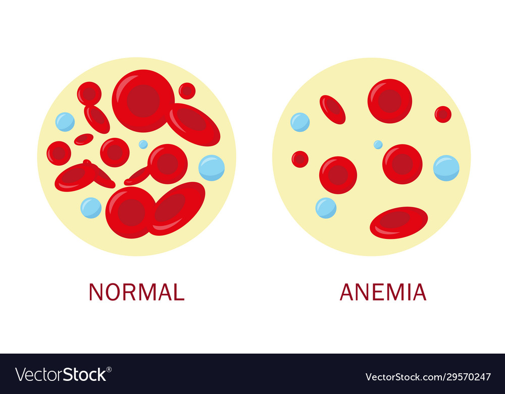 Nolmal blood cell and anemia Royalty Free Vector Image