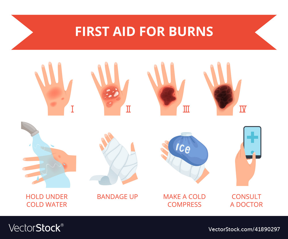 Burn skin first treatment human hand fire Vector Image