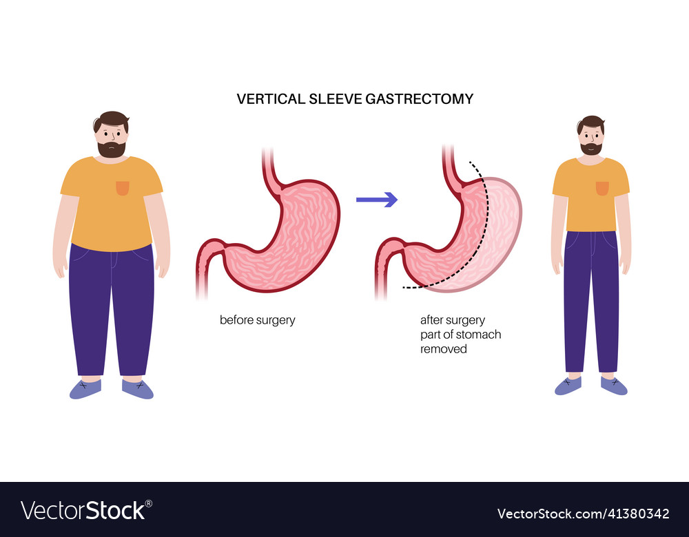 Laparoscopic sleeve gastrectomy Royalty Free Vector Image