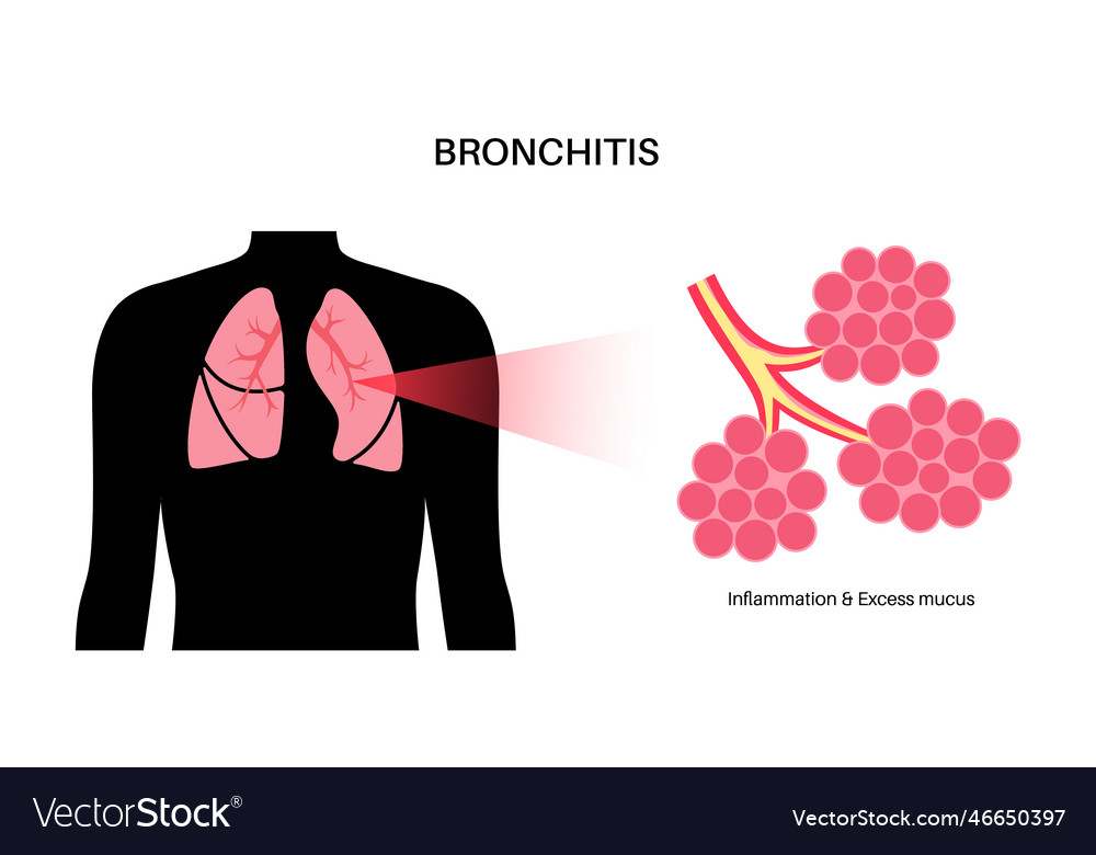 Bronchitis lung disease Royalty Free Vector Image