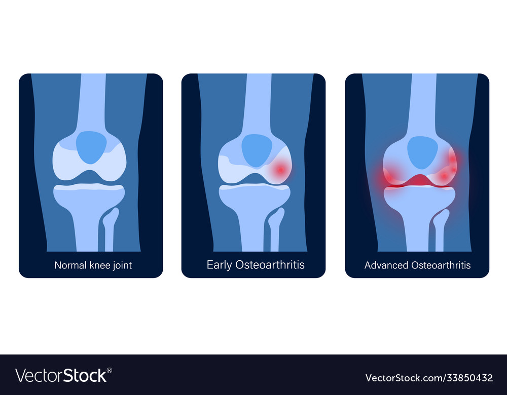 Arthritis in knee joint Royalty Free Vector Image