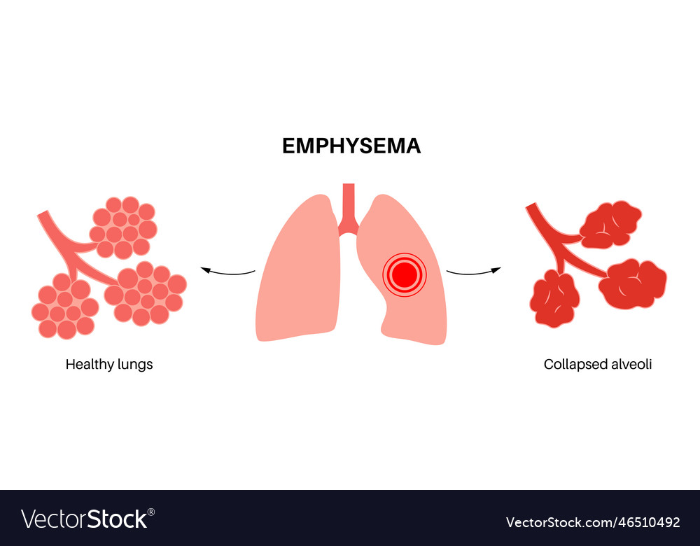 Emphysema anatomical poster Royalty Free Vector Image