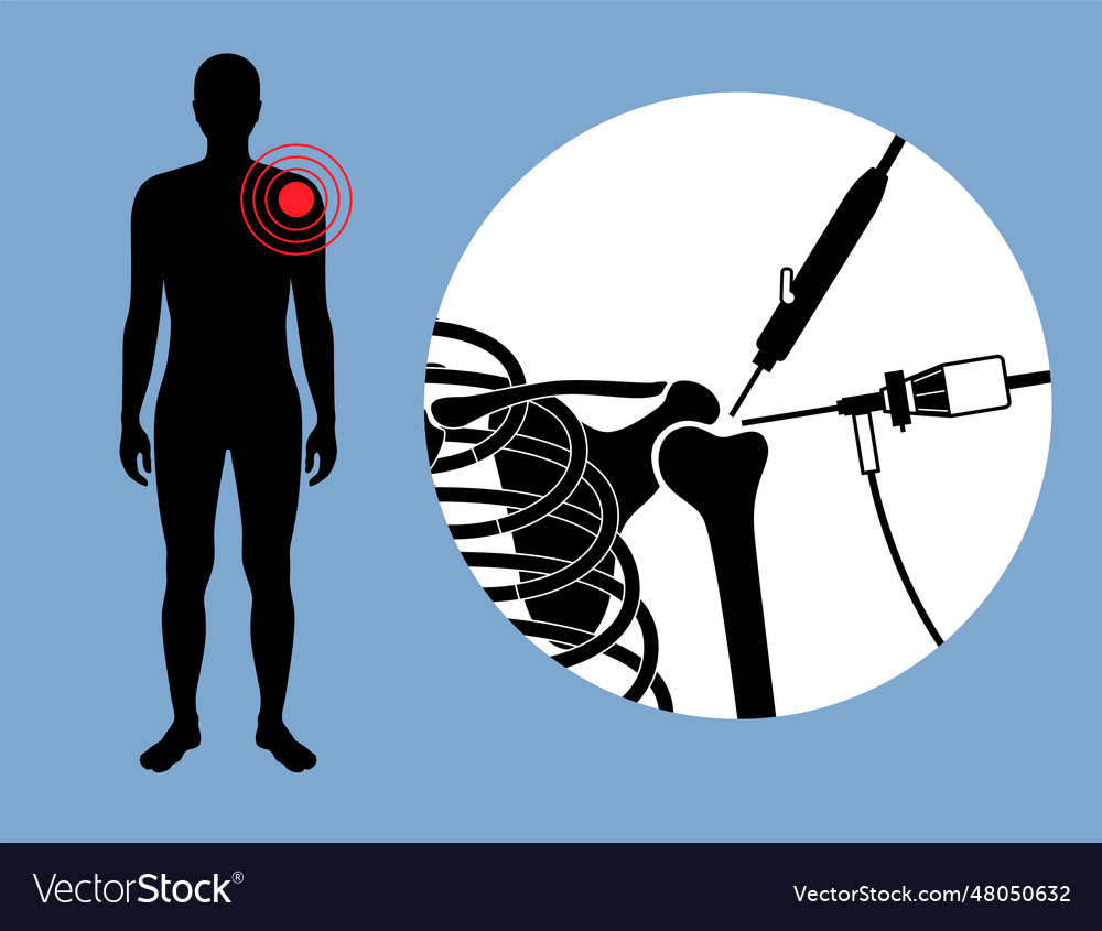 Shoulder arthroscopy poster Royalty Free Vector Image