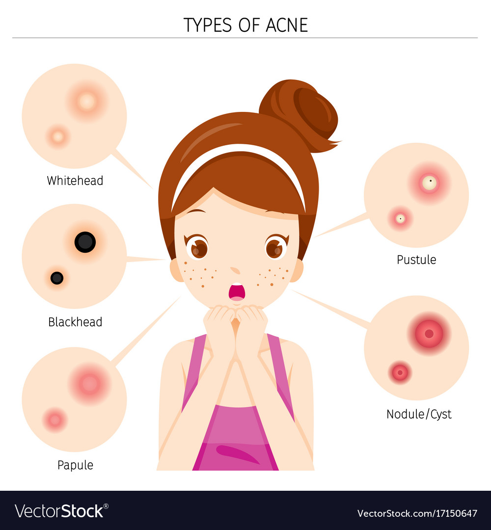 Acne types and girl with acne on face Royalty Free Vector