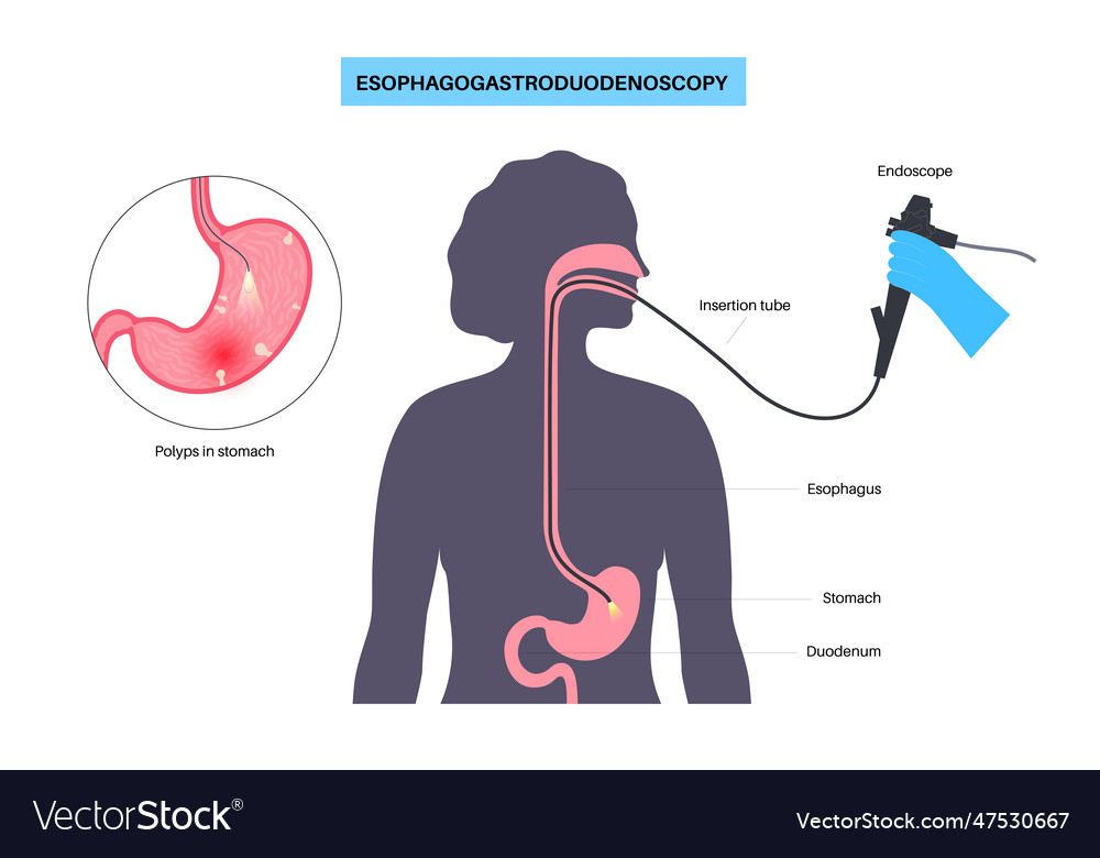 Gastroscopy Endoscopy Procedure Royalty Free Vector Image