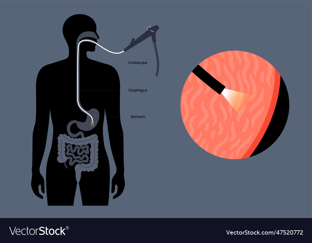 Gastroscopy Endoscopy Procedure Royalty Free Vector Image