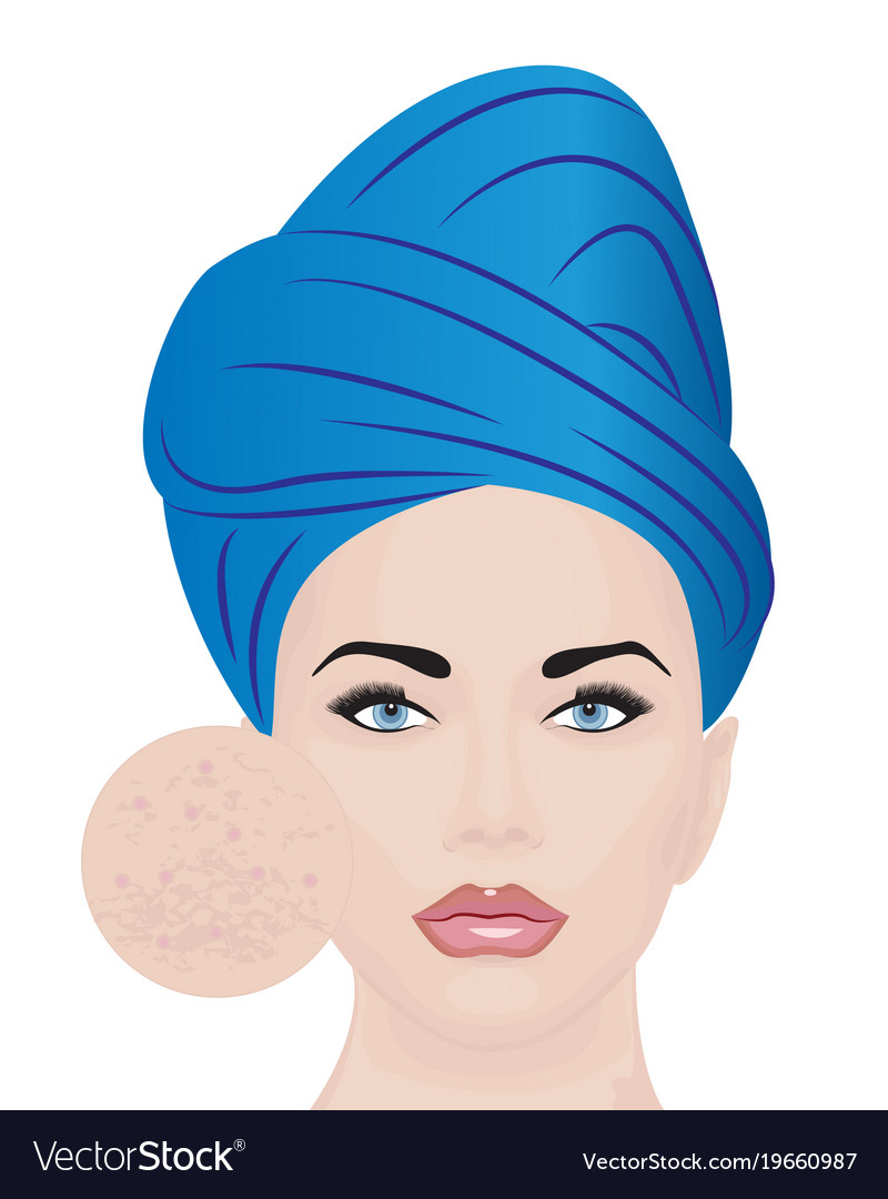 A girl having skin problems Royalty Free Vector Image