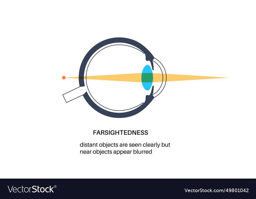 Farsightedness eye disease Royalty Free Vector Image