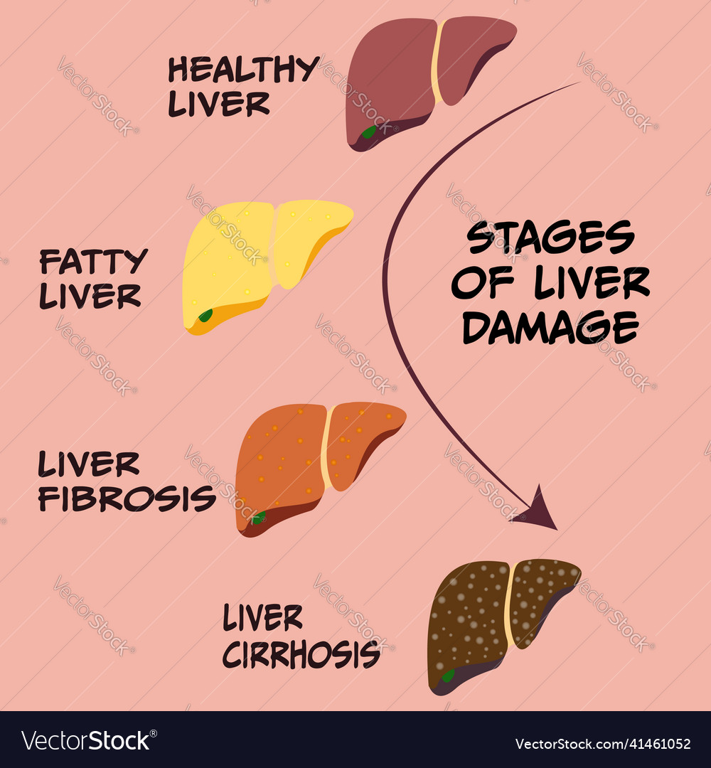 Progression stages of liver disease Royalty Free Vector