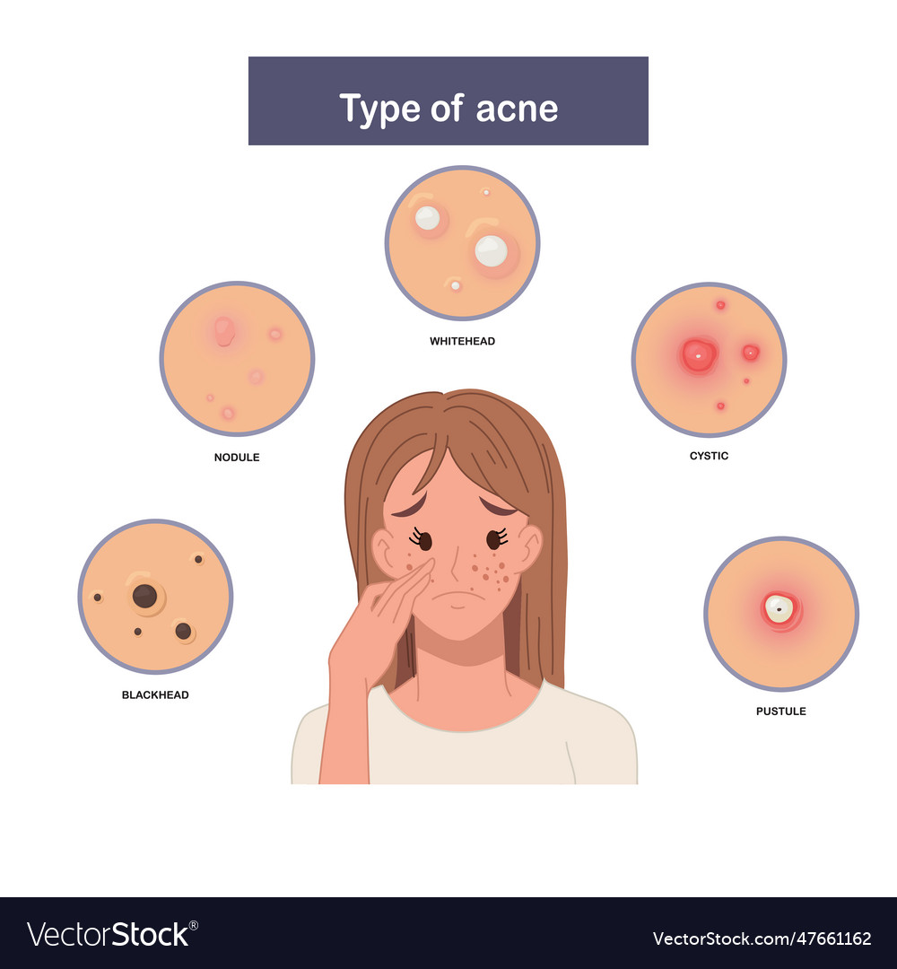 Infographic of type acne sad and worried woman Vector Image