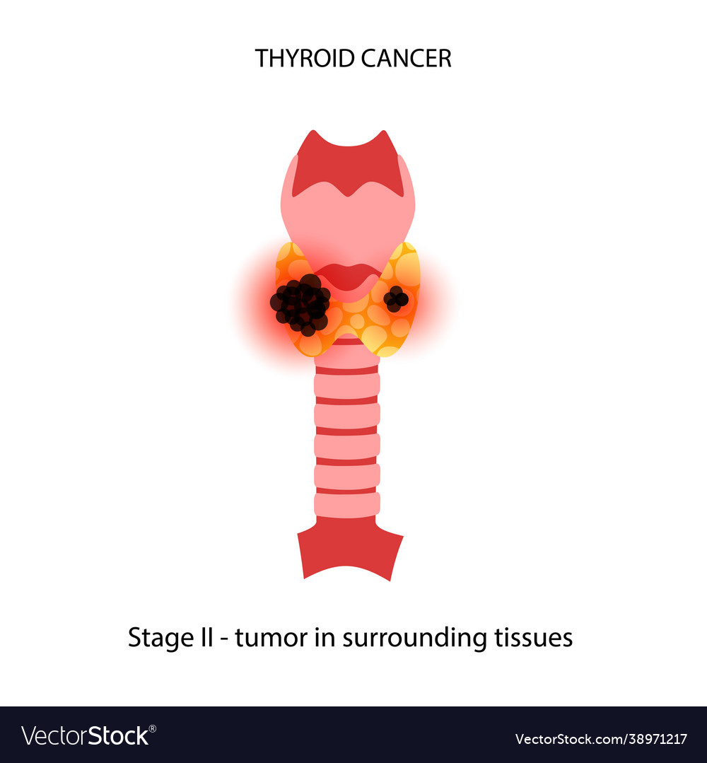 Thyroid cancer stages Royalty Free Vector Image