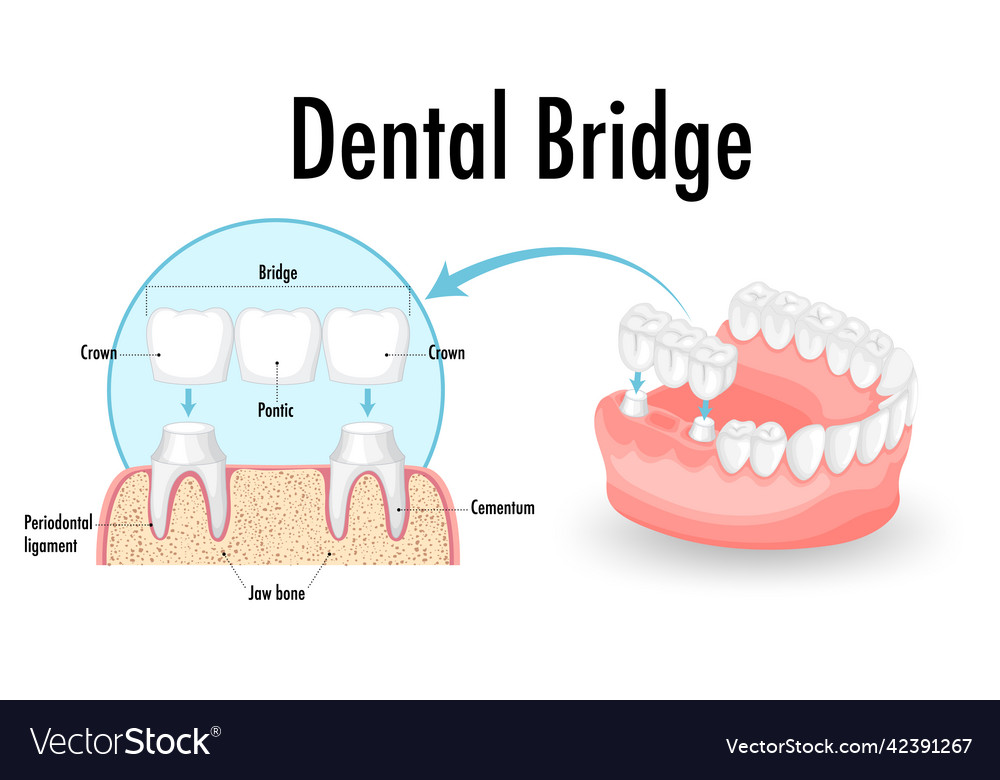 Infographic of human in dental bridge on white Vector Image