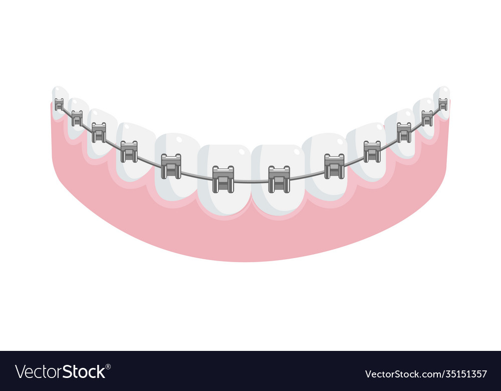 Metal Dental Braces On Straight Teeth In Jaw Gum Vector Image