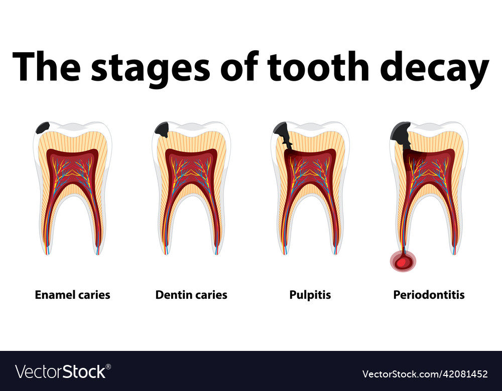 Caries Stages