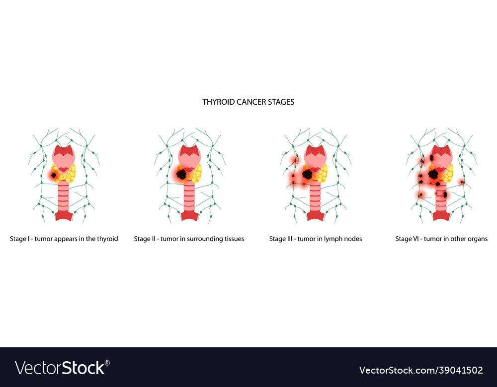 Thyroid cancer stages Royalty Free Vector Image