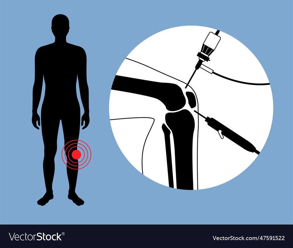 Knee joint arthroscopy