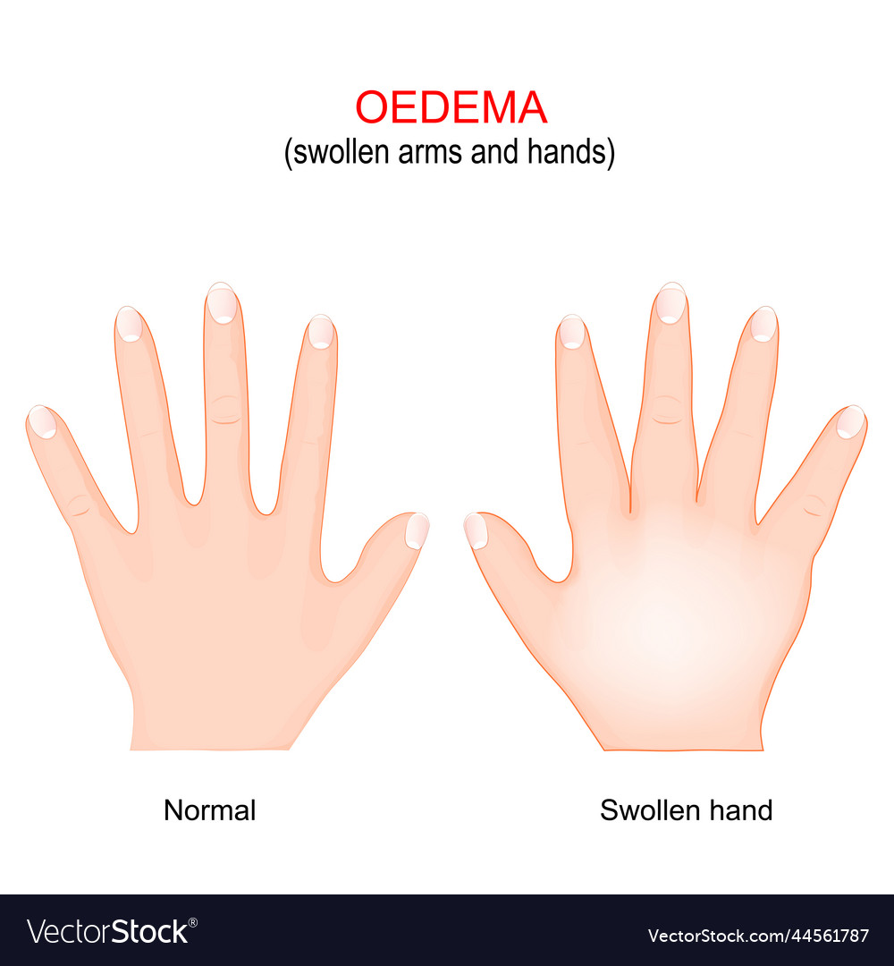 Edema swollen arms and hands oedema