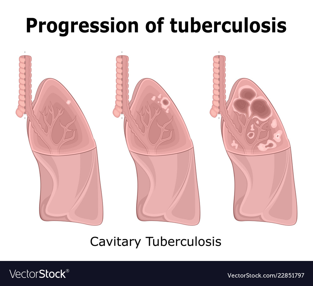 Progression Of Tuberculosis Royalty Free Vector Image