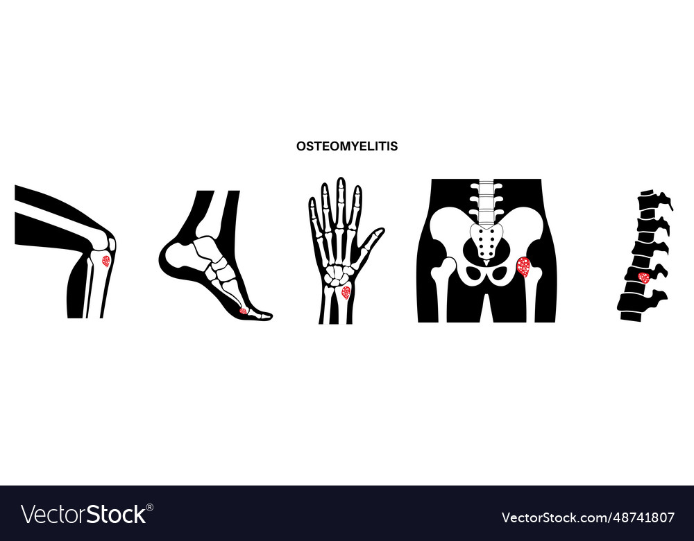 Osteomyelitis disease poster Royalty Free Vector Image