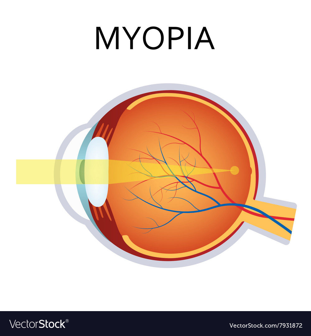 myopia 2. fokú myopia