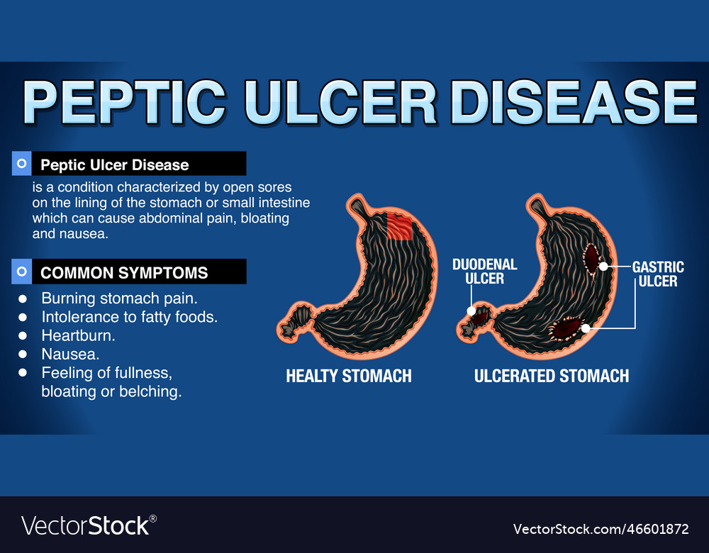 Peptic ulcer disease explained infographic Vector Image