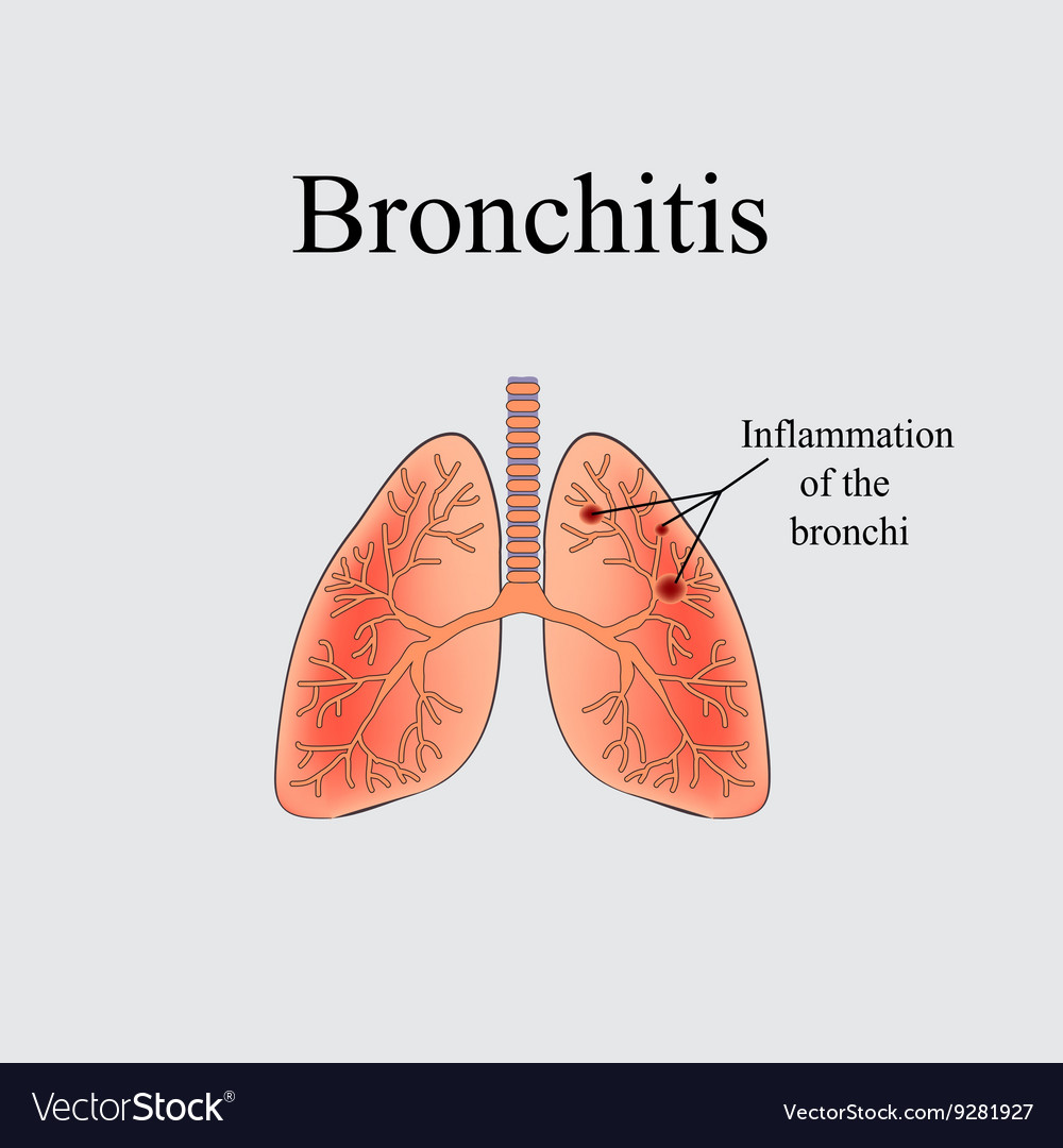 Bronchitis the anatomical structure of human Vector Image