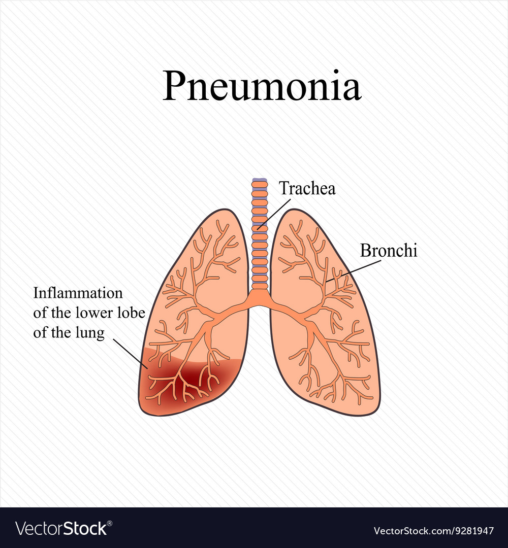 Pneumonia the anatomical structure of human Vector Image