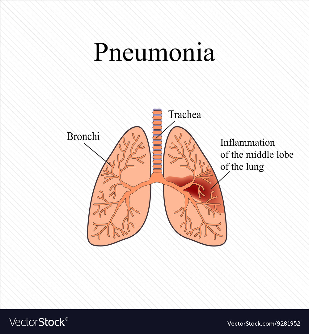 Pneumonia the anatomical structure of human Vector Image