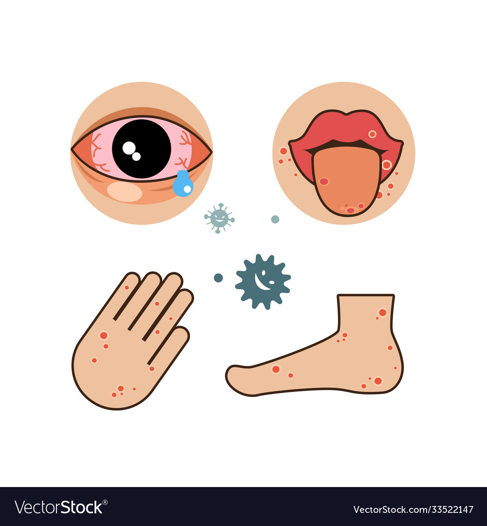 Hand disease Royalty Free Vector Image - VectorStock