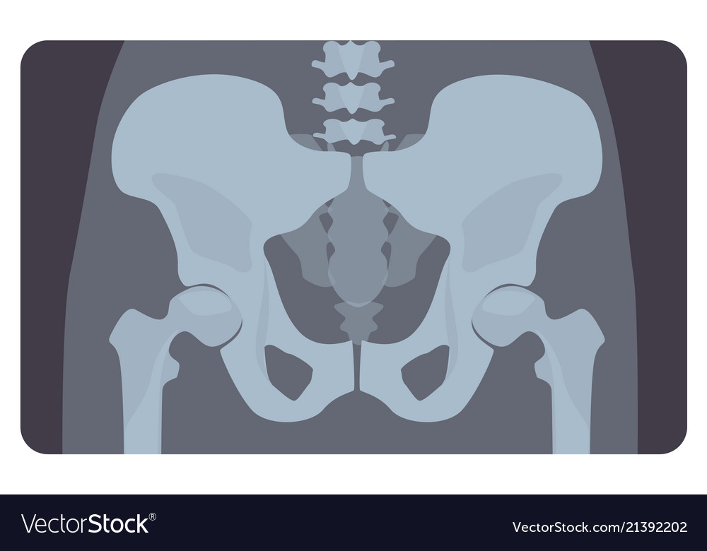 Anterior radiograph of human pelvis or hip bone