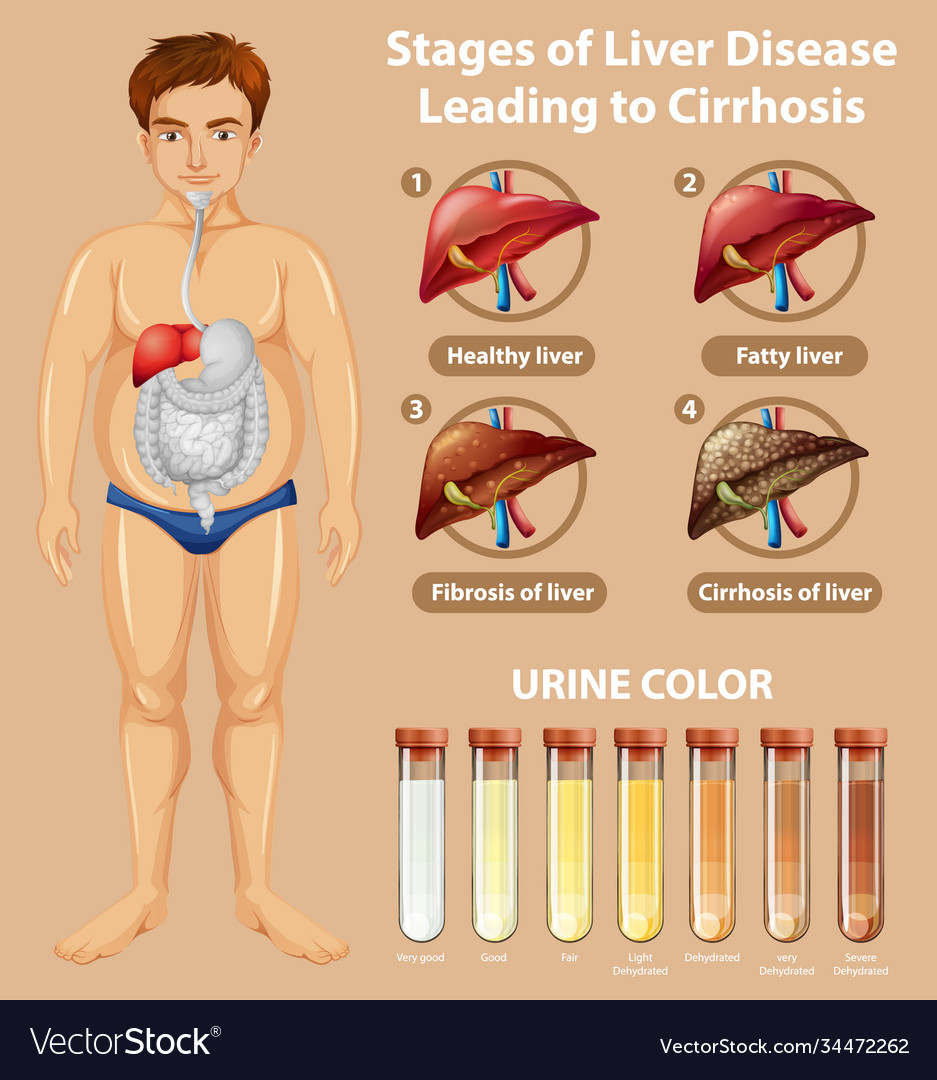 Stages liver disease leading to cirrhosis Vector Image