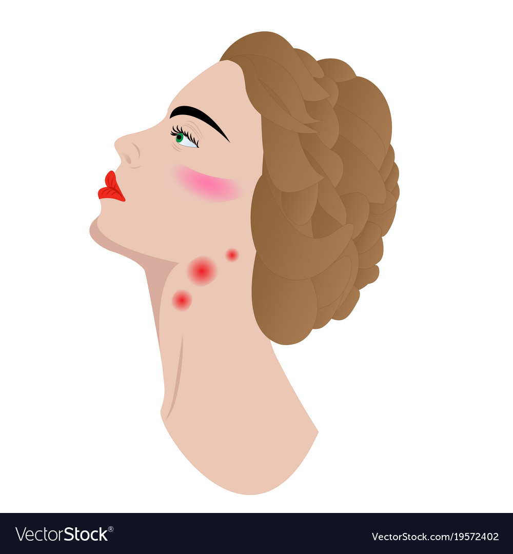 swollen-lymph-nodes-in-womans-neck-royalty-free-vector-image