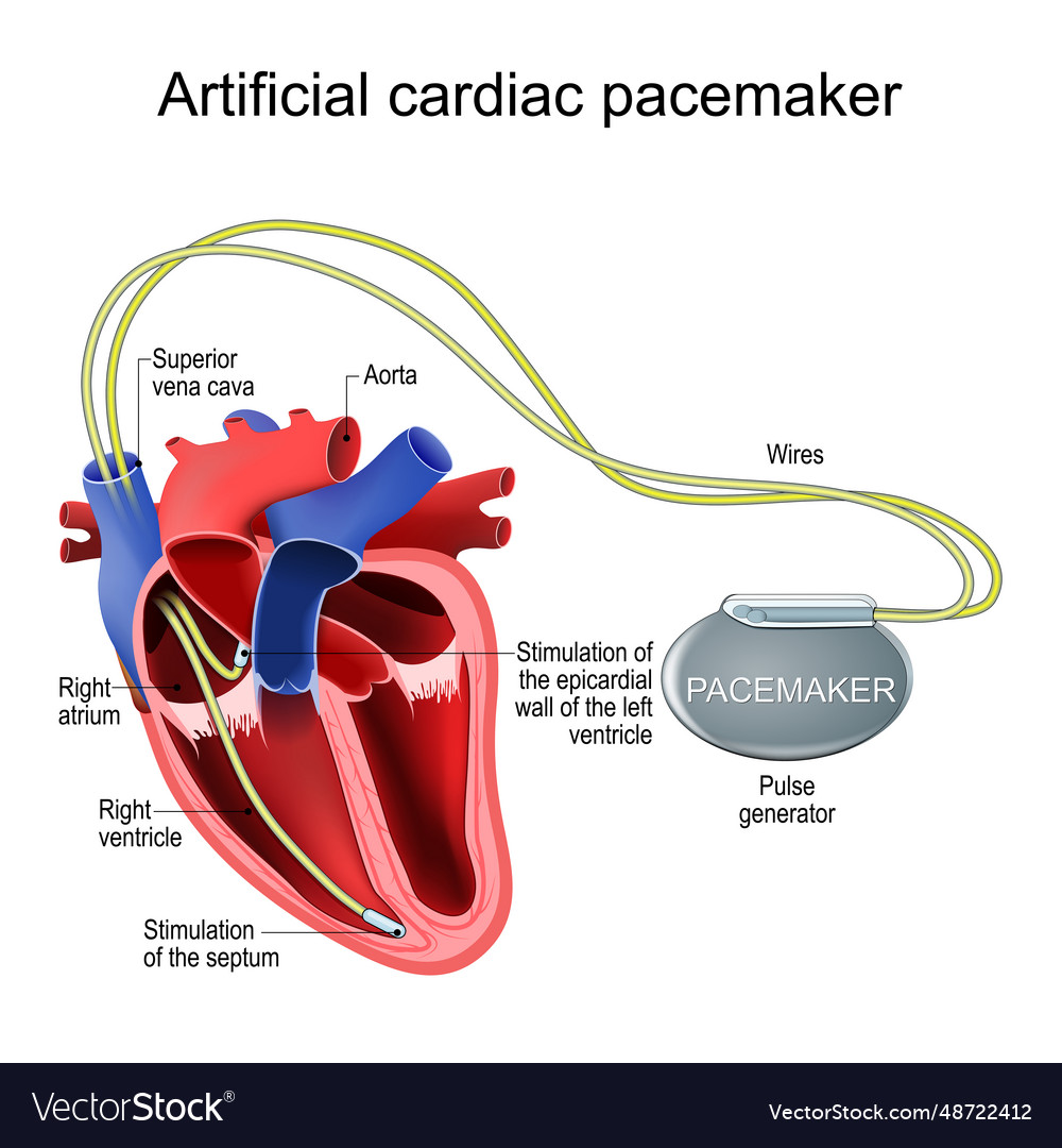 Artificial cardiac pacemaker heart implant vector image