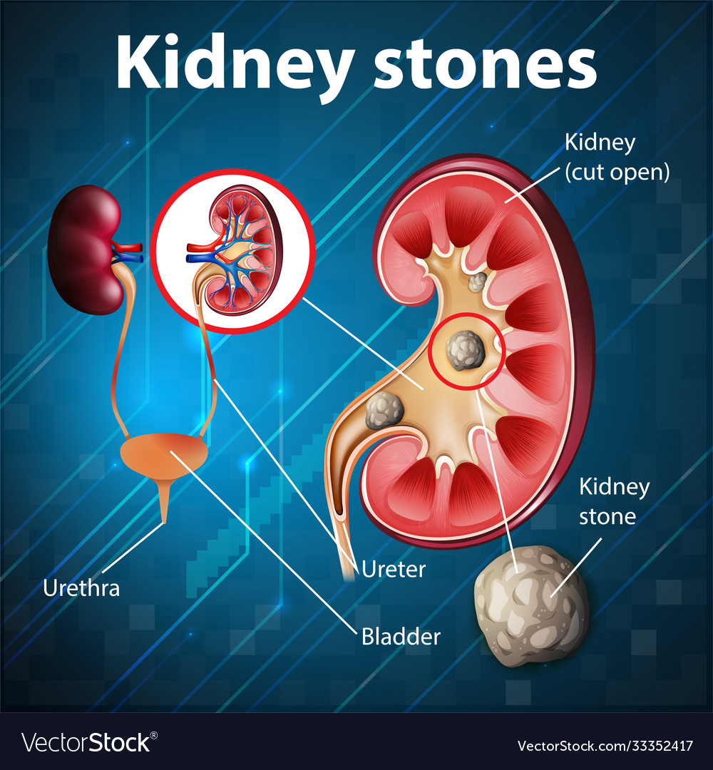 Informative Kidney Stones Royalty Free Vector Image