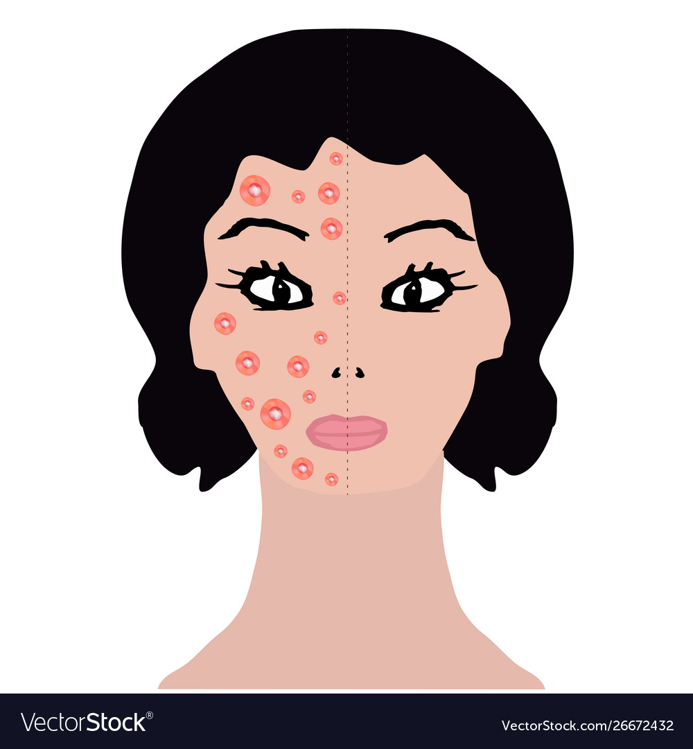 Rash on face allergy dermatitis acne pimples Vector Image