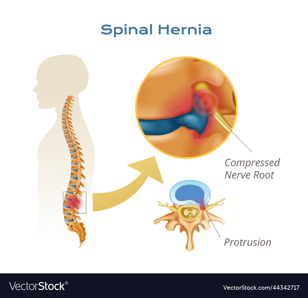 Spinal Hernia Anatomy Infographics Royalty Free Vector Image