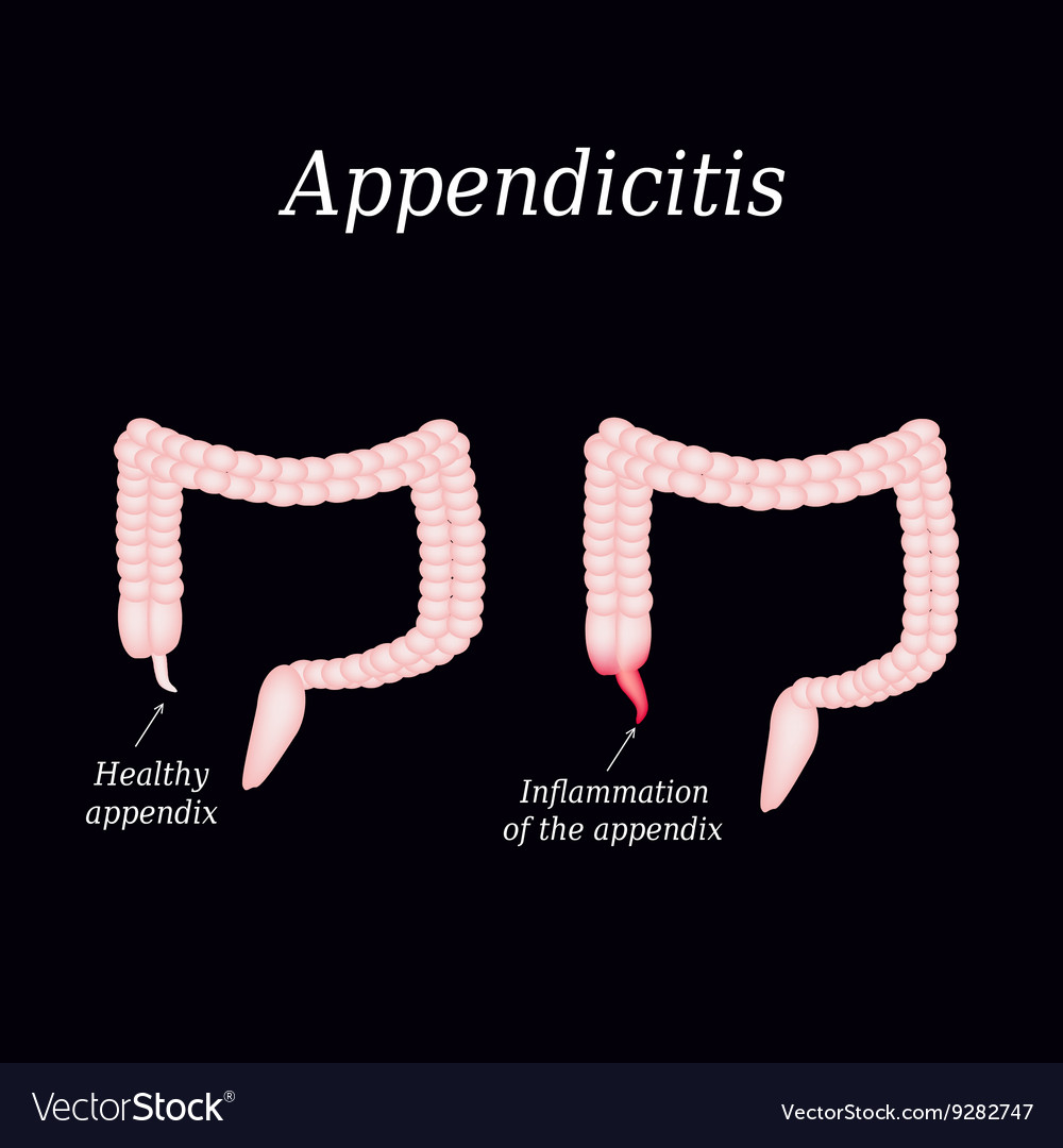 Appendicitis inflammation of the appendix colon Vector Image