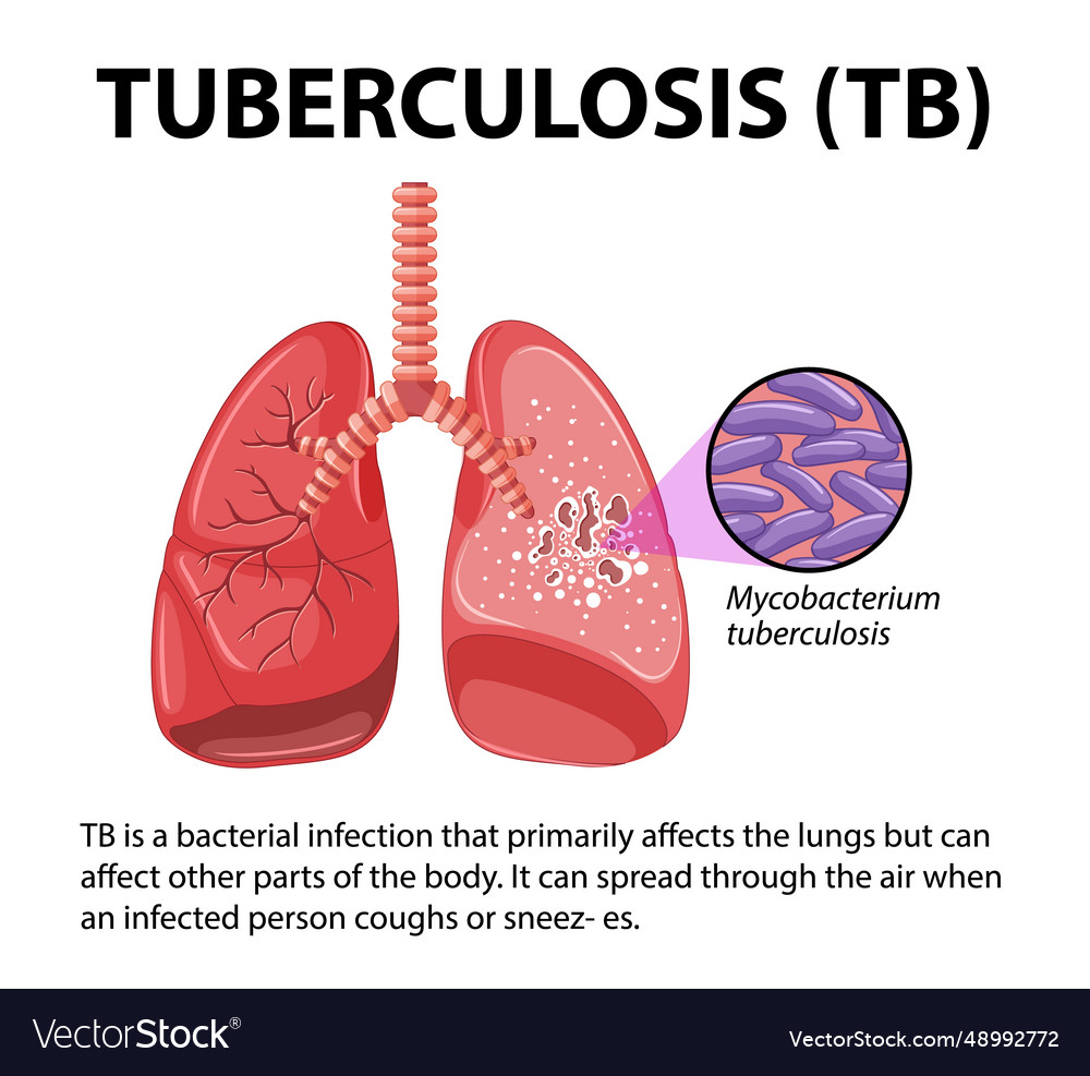 Human anatomy of lung with tuberculosis Royalty Free Vector