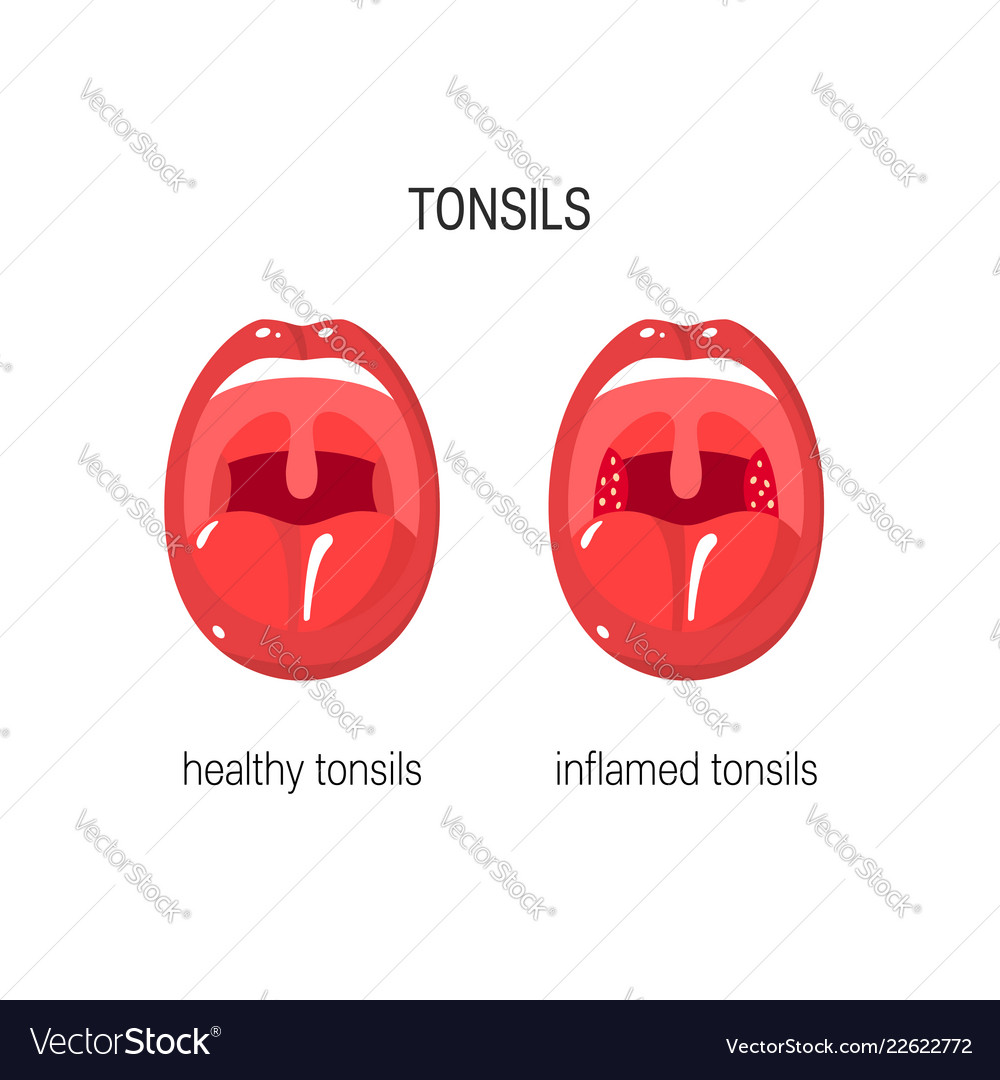 Tonsils Royalty Free Vector Image - VectorStock