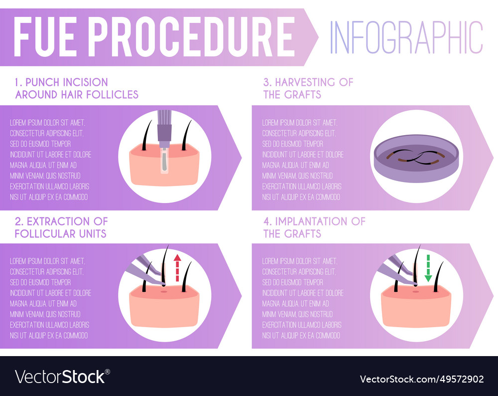 Medical infographic about hair transplantation Vector Image