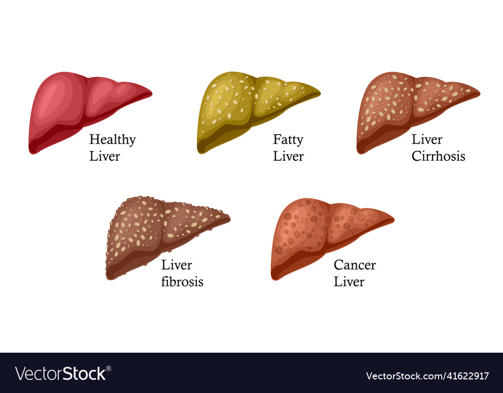 Stages of liver damage liver disease Royalty Free Vector