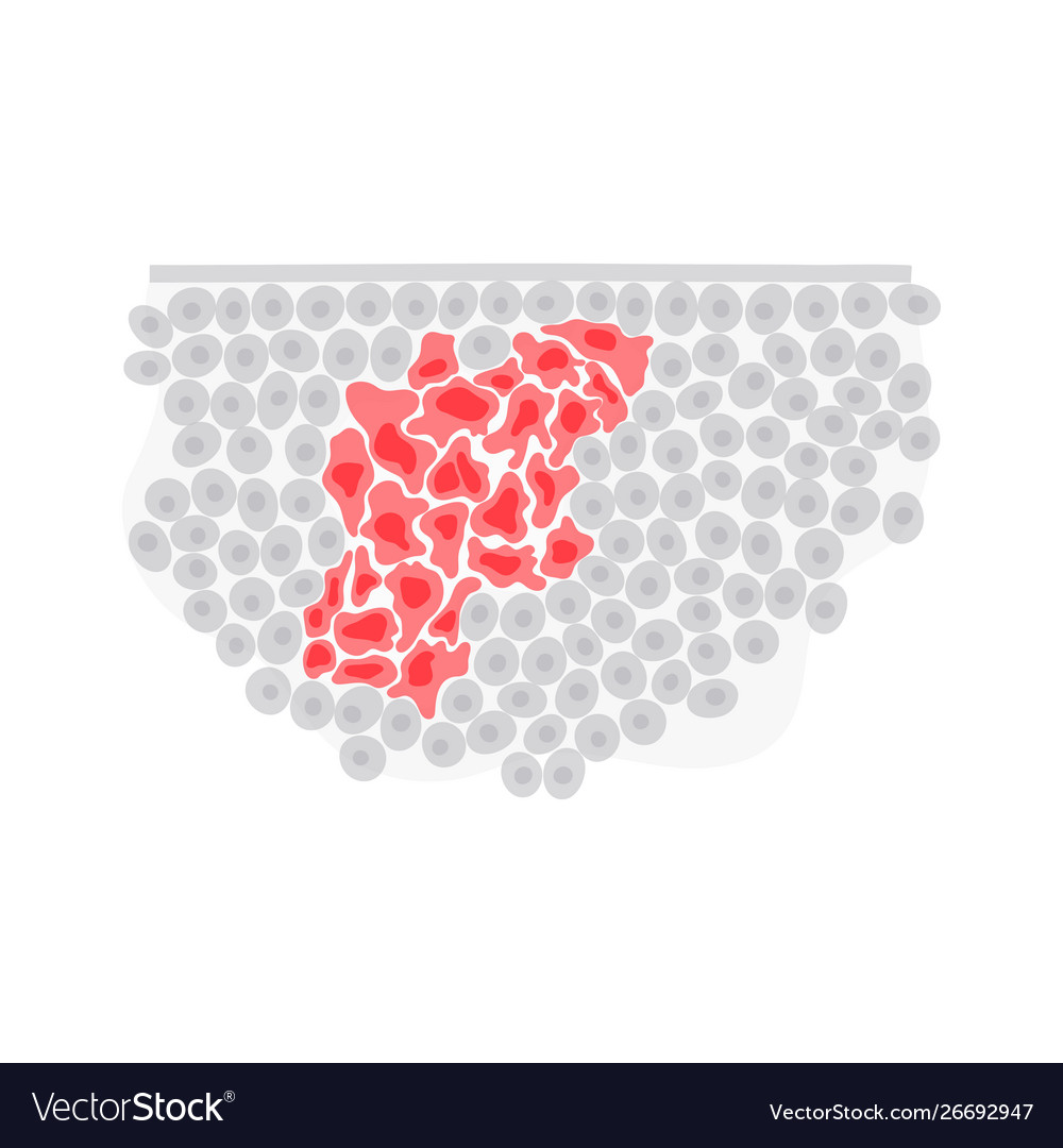 Isolated malignant tumor Royalty Free Vector Image